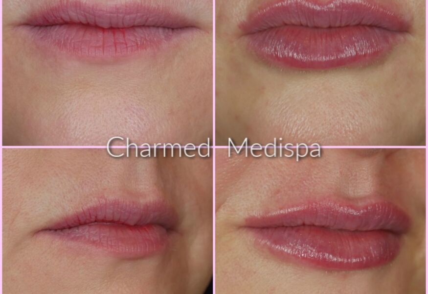 Lip filler results Delaware med spa