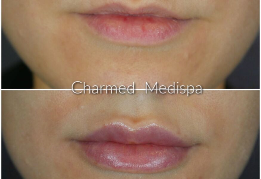 Lip filler at Charmed Medispa to enhance volume and shape of the upper and lower lips