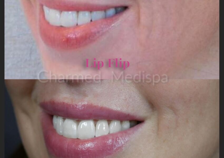 Lip flip results at Charmed Medispa Newark, Delaware