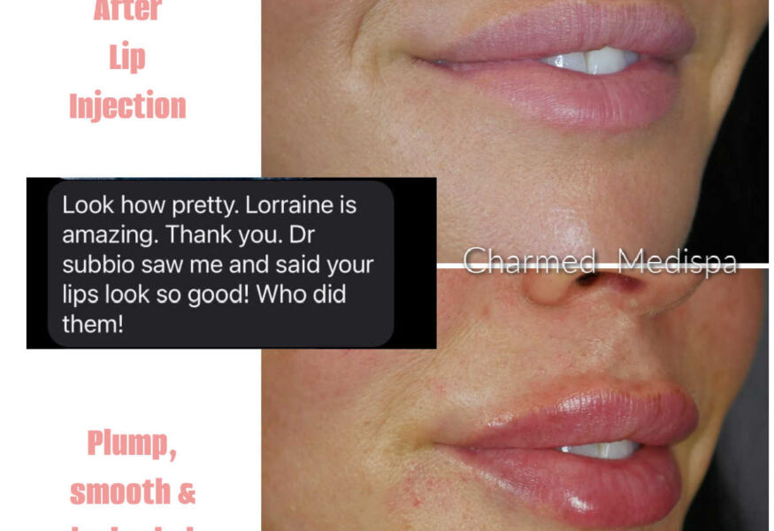 Lip injections with dermal filler at Charmed Medispa using Restylane Defyne