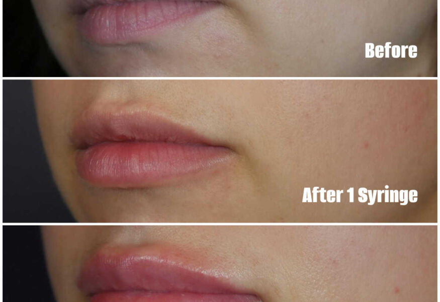 Lip Injections with 2 sessions of dermal filler using one syringe per visit. Ultimately, she wanted more volume and settled with two syringes.