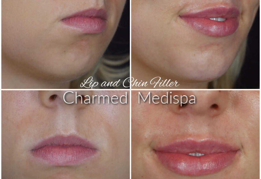 Dermal filler was used on the lips and chin for smoothening and chin contour.