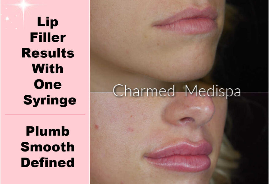 One syringe of lip filler was used to create lips that are plumper and smoother.