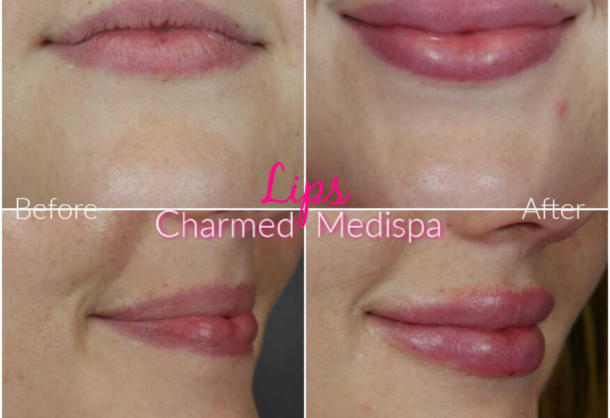 Lip filler at the highest ranked medispa in Delaware. Natural, smooth results.