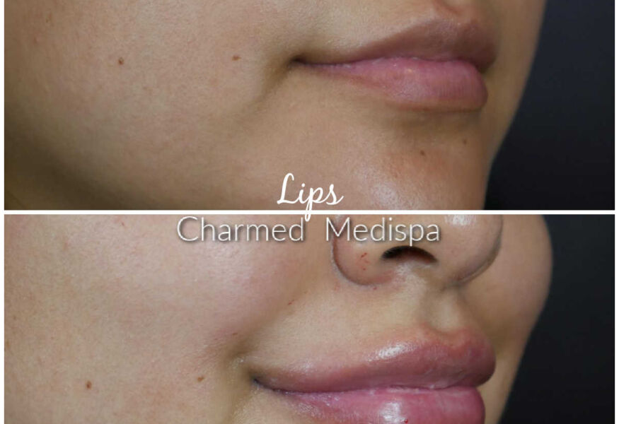 One syringe of lip filler to enhance the lip volume and shape.