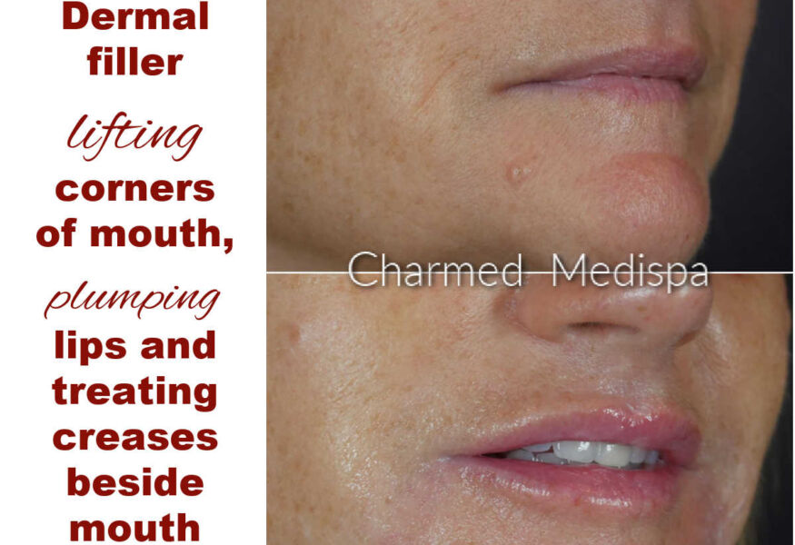 Downturn of the mouth and lip injections at Charmed Medispa in Newark, Delaware