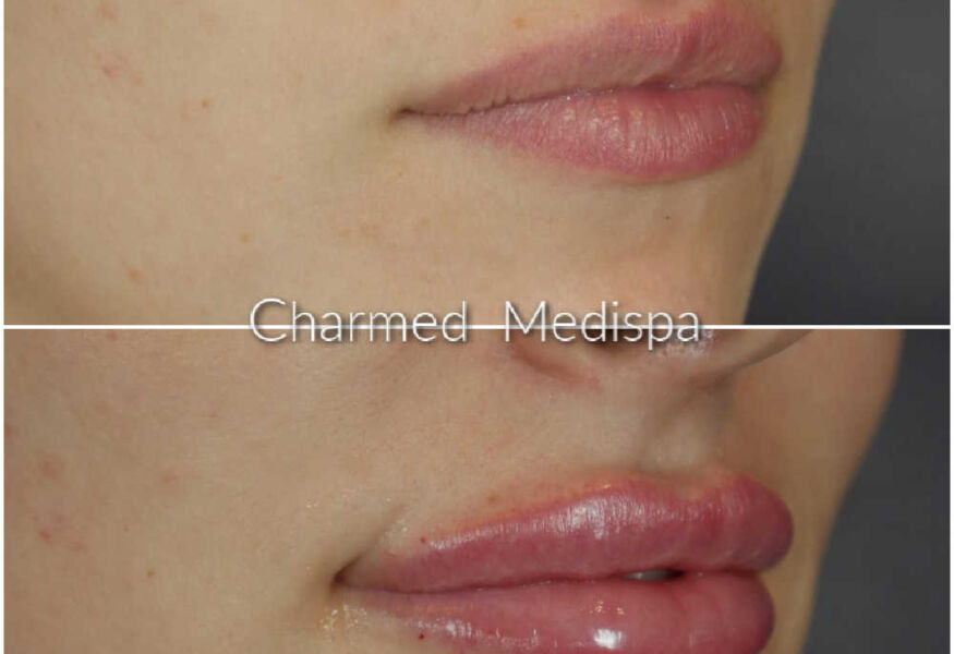 Charmed Medispa specializes in lip filler. Look at this beautiful before and after lip filler result.