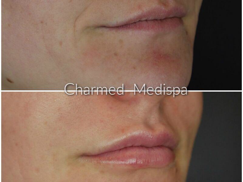 Lip filler at Delaware med spa.