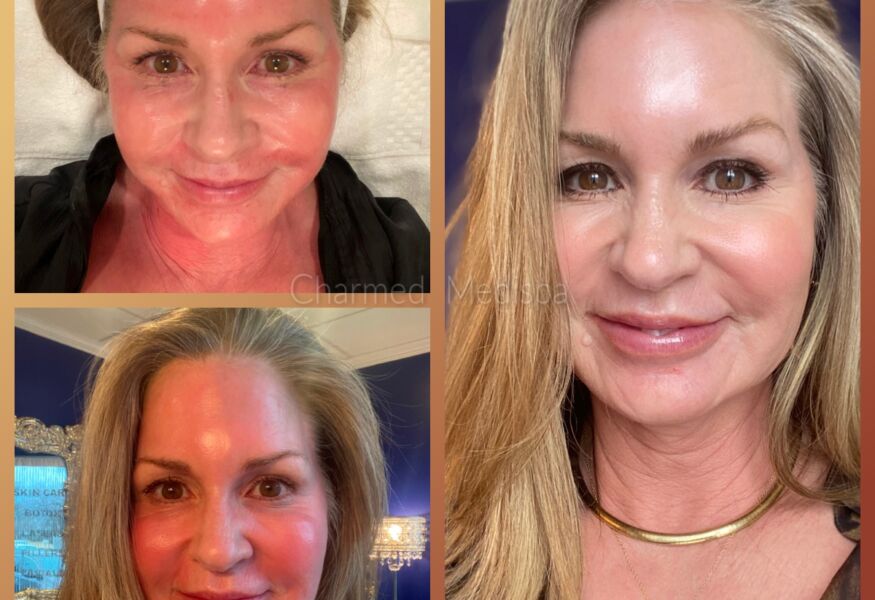 Microneedling of the face, neck and chest area at Charmed Medispa to improve wrinkles, fine lines and crepey skin.