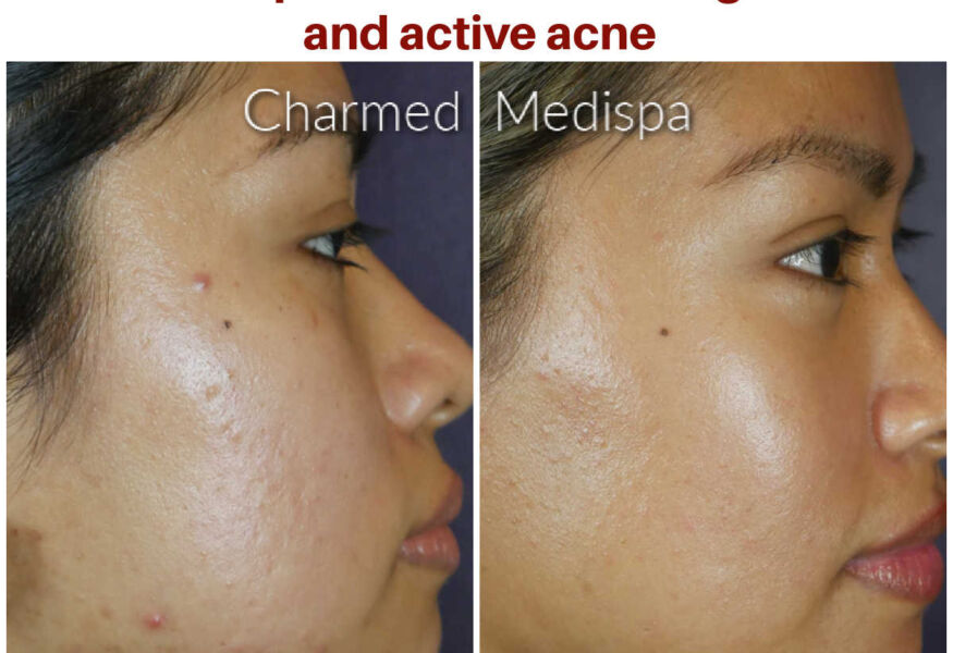 Acne and acne scarring were improved with a series of microneedling treatments at Charmed Medispa in Newark, Delaware.