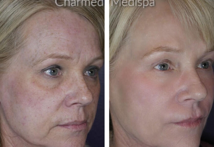 Improvement of redness, photodamage and wrinkles with microneedling, skin care, IPL and dermal fillers