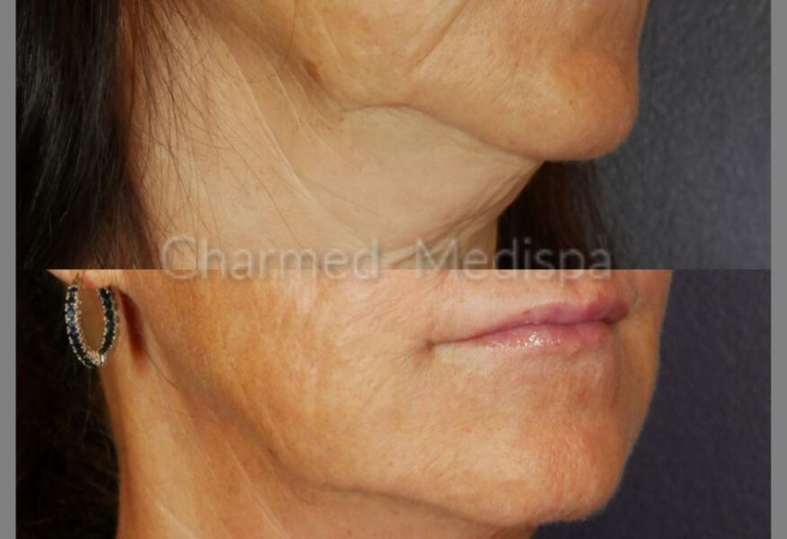 Microneedling of the face to improve skin contour and health.