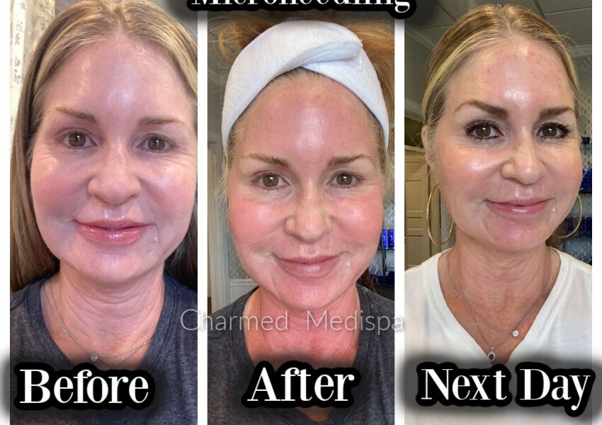 Microneedling of the face and neck before and after photos at our Delaware med spa