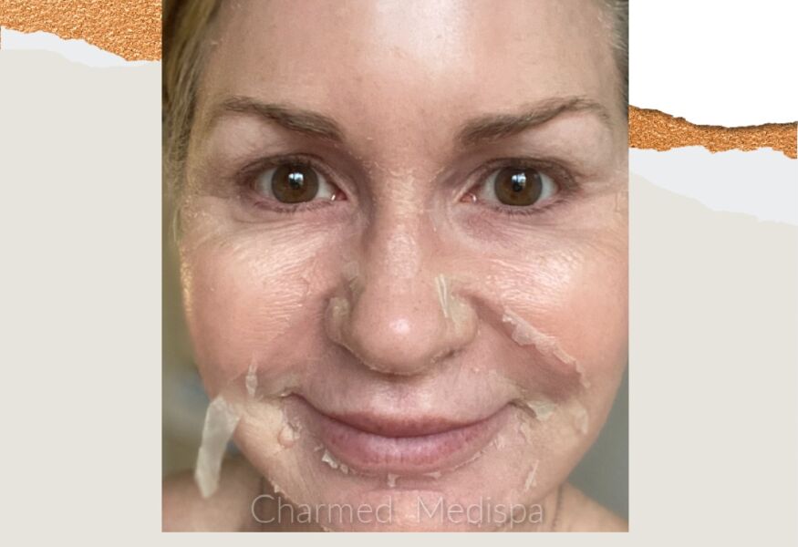 ZO Skin Health 123 Step Peel was used to improve wrinkles and sun damage. Our Delaware med spa can condition and revive your skin and make it glowing and radiant.