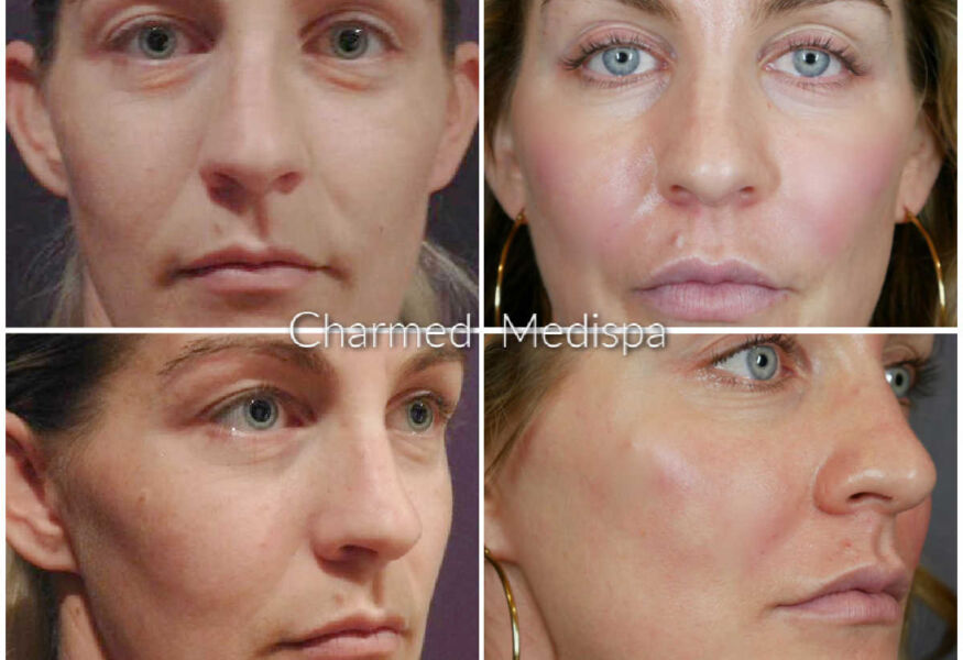 Botox and Filler Delaware Medispa to lift cheeks, enhance lips and soften folds. Latisse to grow lashes and skin care for healthy glow.