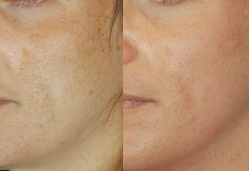 Results of ZO Skin Health improving texture, pigmentation and wrinkles