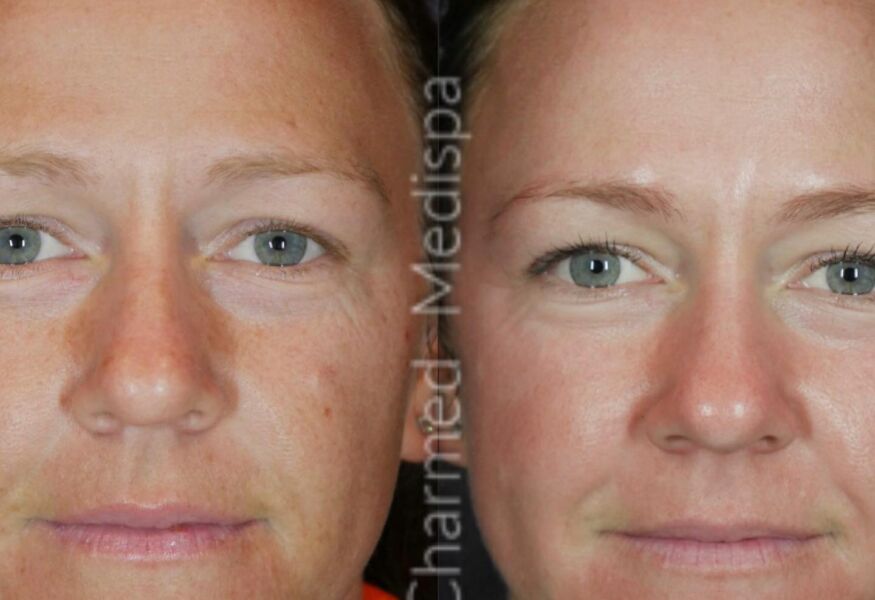Before and after photos of our medical grade skin care results using ZO Skin Health.