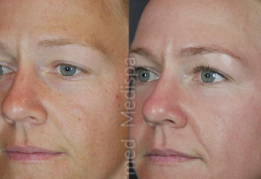 Remove sun spots and get glowing skin with our custom medical grade skin care products at Charmed Medispa.