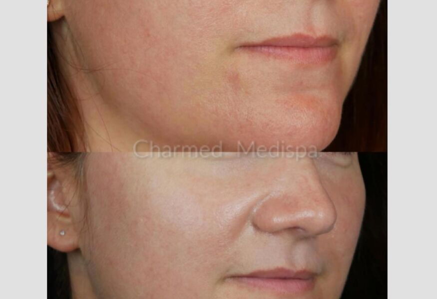 Rosecea treatment at Charmed Medispa with skin care.