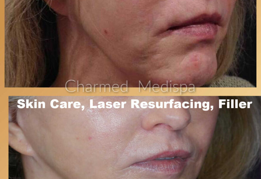 Laser resurfacing was used to improve acne scarring and overall wrinkles.