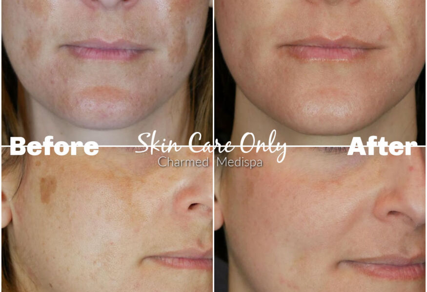 Melasma treated successfully with ZO Skin Health