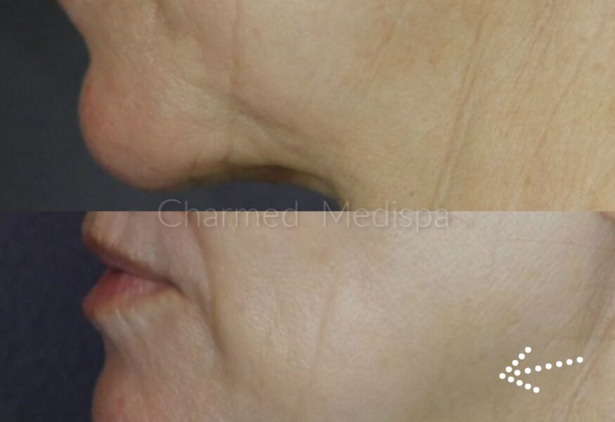 Skin tightening of the face using Exilis Ultra in our Delaware med spa.