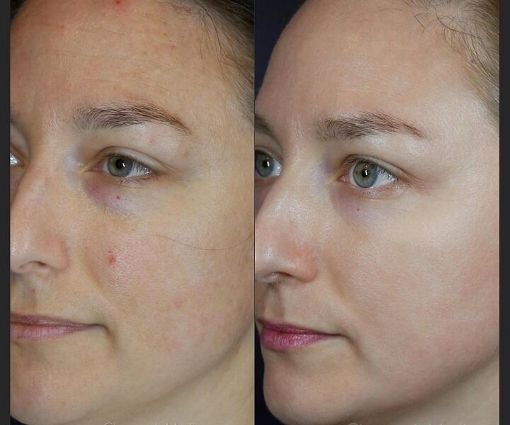 ZO Skin Health skin transformation Delaware med spa results