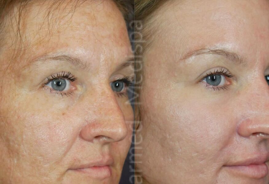 Results using ZO Skin Health by Dr. Obagi. Our medical spa in Delaware offers complete skin care management.