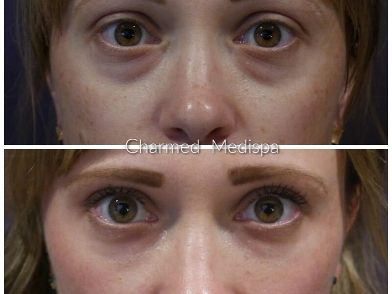 Filler in the tear trough and skin care with ZO Skin Health at our Newark, Delaware med spa