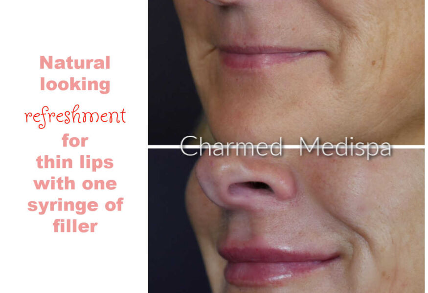 One syringe of filler for thin lips gave a natural looking enhancement at our Delaware med spa.