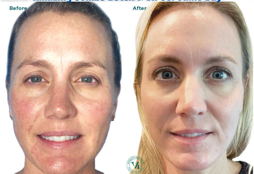 ToxBooster results of ViPeel and Botox performed the same day