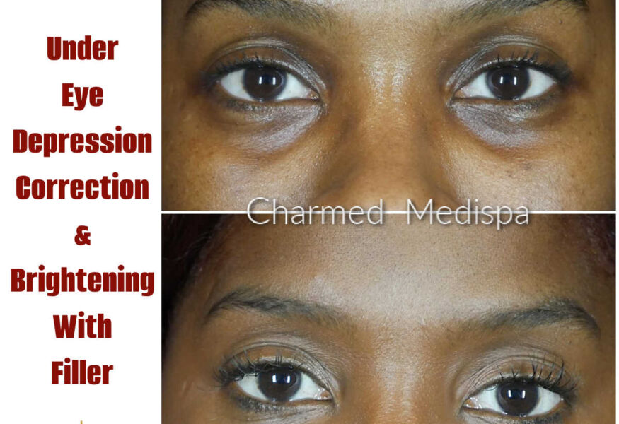 Dermal fillers can be used to boost collagen and lift contours under the eyes to brighten the eyes and minimize hollowness and make patients look less tired.