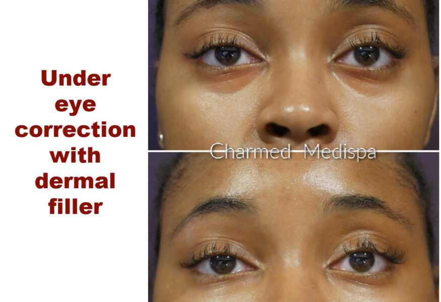 Dermal fillers were used for under eye correction to improve darkness and hollow contours.