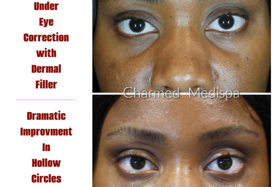 Dermal filler to correct under eye depression and hollowness giving her brighter appearance