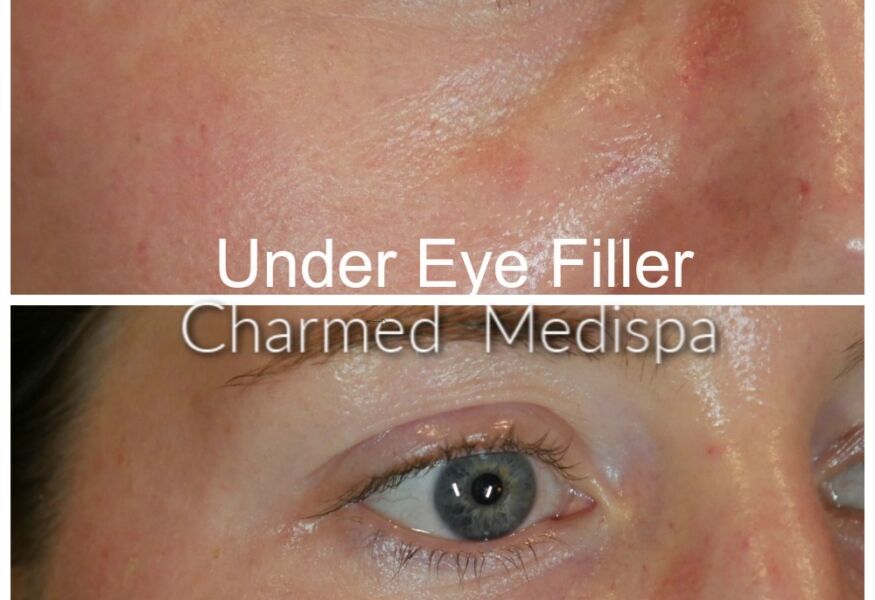 Charmed Medispa under eye filler to improve the depression and tear trough