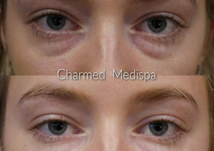 Under eye refreshment with one syringe of dermal filler to improve the hollowness and darkness.