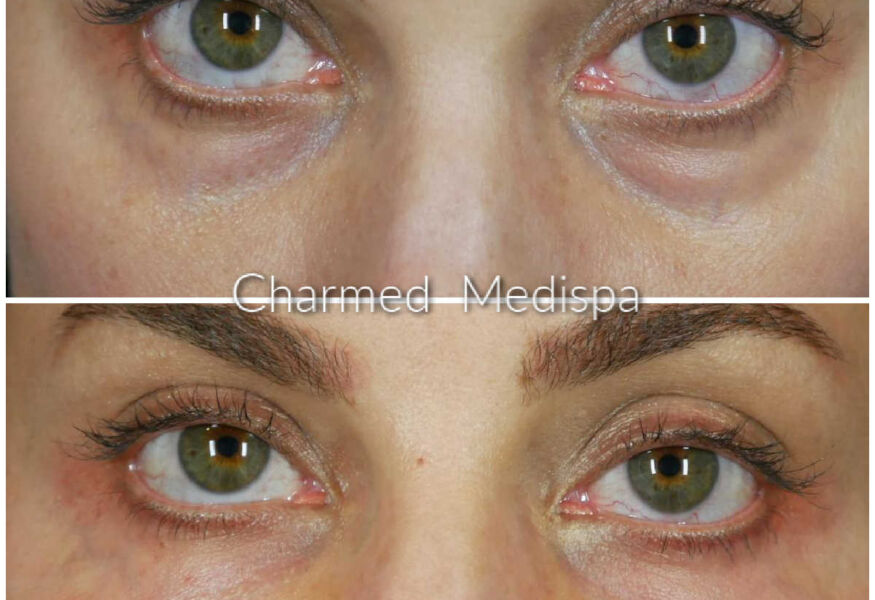 One syringe of filler used to improve circles and darkness under eye eyes. Our Delaware med spa specializes in the fine art of dermal fillers like Restylane and Juvederm.