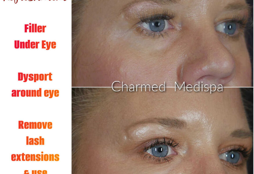 Under eye correction with dermal filler and dysport around the eyes to lift the brows.