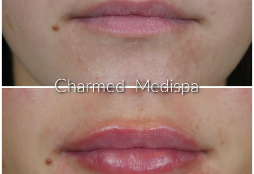 Lip filler to upper and lower lip at Delaware Med Spa