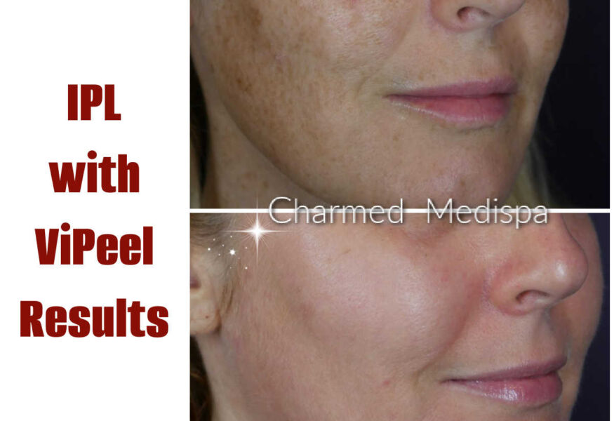 Results of IPL with ViPeel for facial pigmentation and improvement in skin tone and texture at Charmed Medispa