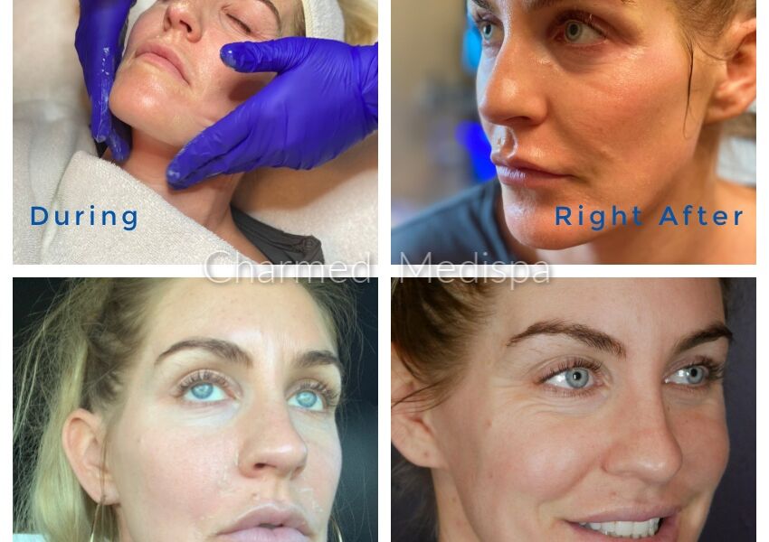 The ZO Skin Health 3 Step Peel during and after. This chemical peel provides significant improve in tone, textures and pigmentation of the skin.