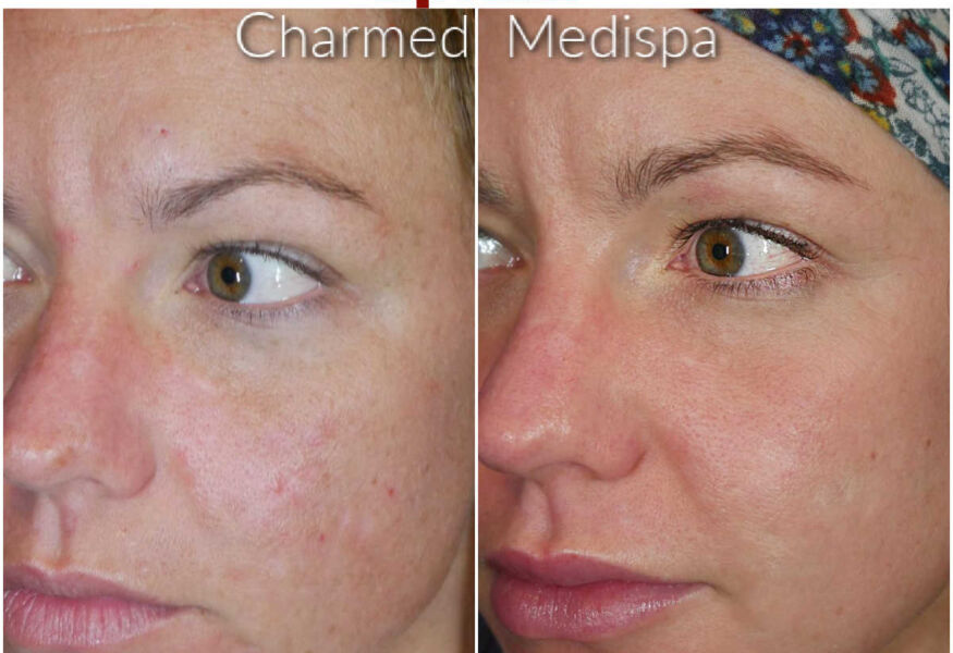 ZO Skin Health was used to control and improve acne. The 3 Step Peel was used to manage acne scarring, tones and skin texutres and balance the skin. Lip injections were used to plump and restore volume with natural looking results.