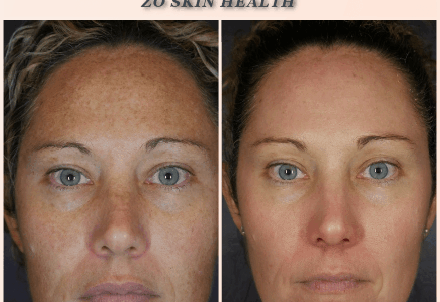 Charmed Medispa used ZO Skin Health customized protocol to improve pigmentation, sun damage, wrinkles and to even out skin tones.