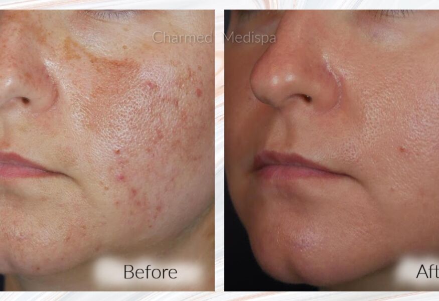 Melasma and uneven skin tones were dramatically improved with ZO Skin Health and our medical grade skin care protocol at Charmed Medispa.