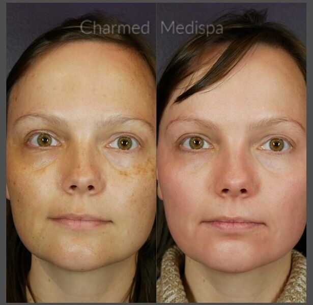 Improve melasama and sun damage with ZO Skin Health managed by our expert med spa team.