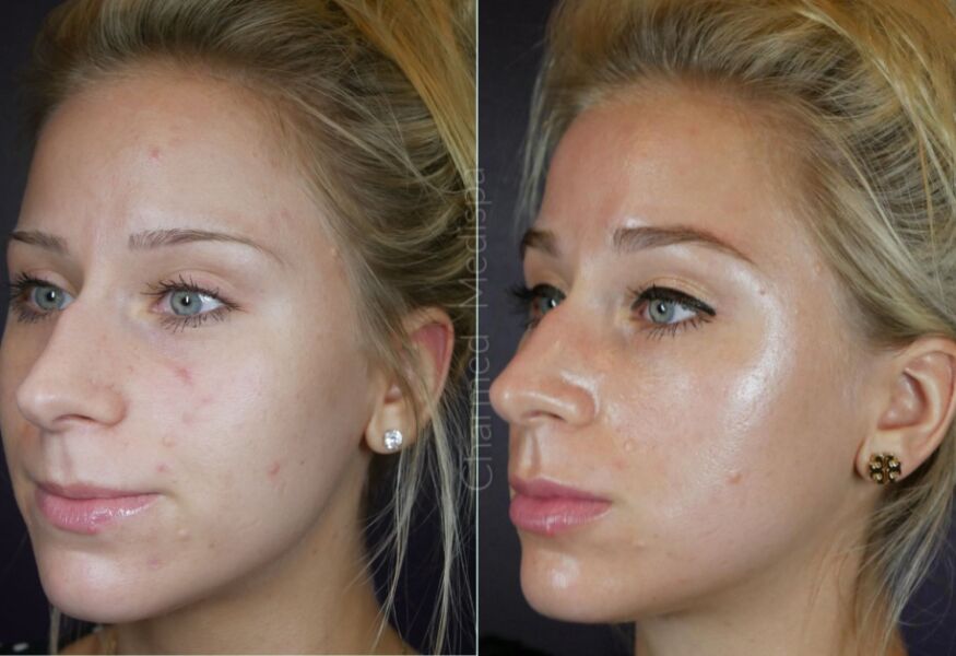 Customized ZO Skin Health products combined with a series of microneedling