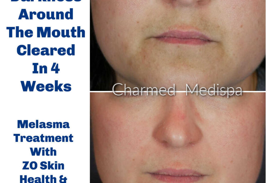 Improvement of darkness and melasma around the mouth using ZO Skin Health products.