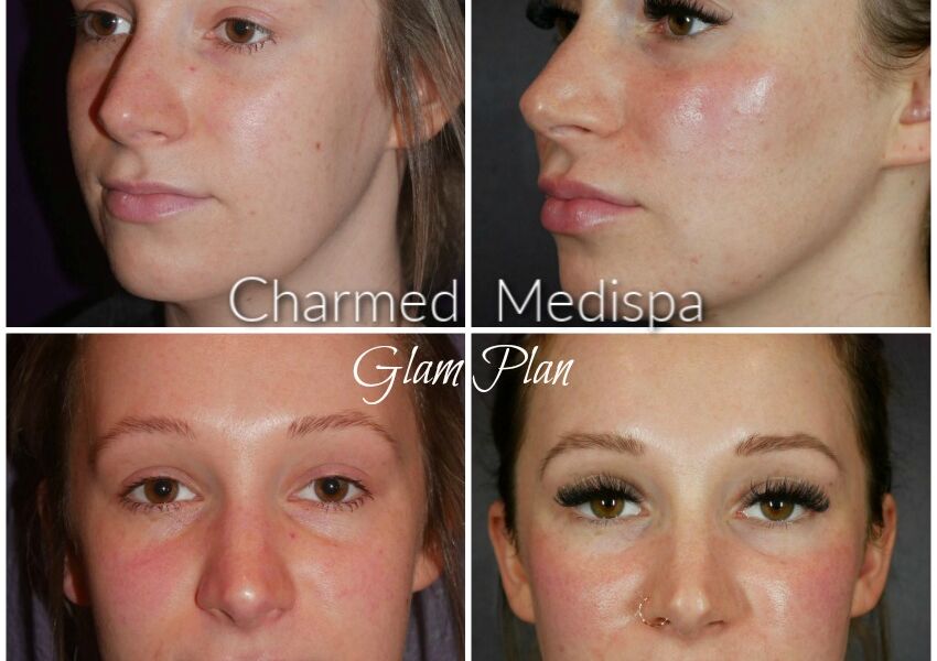 Filler in cheeks and lips. Skin care and refreshment at our Delaware med spa.