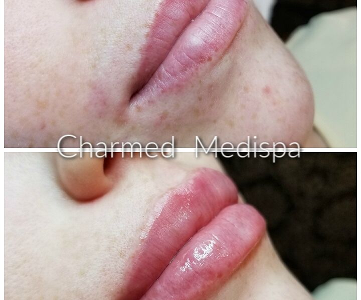 Lip filler results with one syringe of filler for plumper and smoother lips. Lip filler at our Delaware med spa is very popular and ranked highly satisfying.
