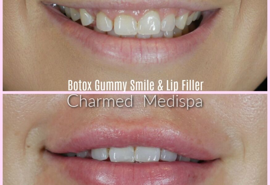 Botox Gummy Smile and Lip Filler to correct asymmetry of the lips and smile with excessive gums showing